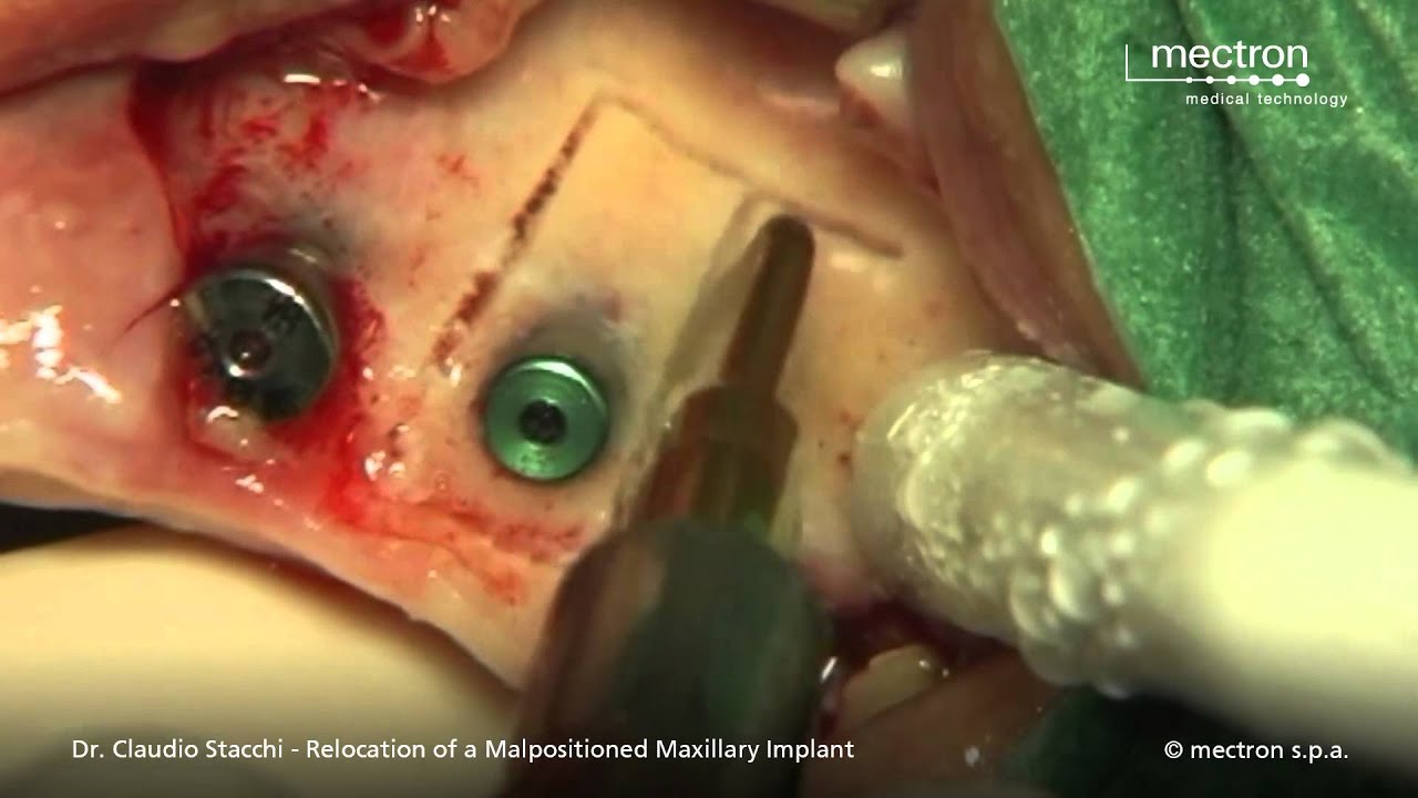 PIEZOSURGERY® — Relocation of a Malpositioned Maxillary Implant by Dr. Claudio Stacchi