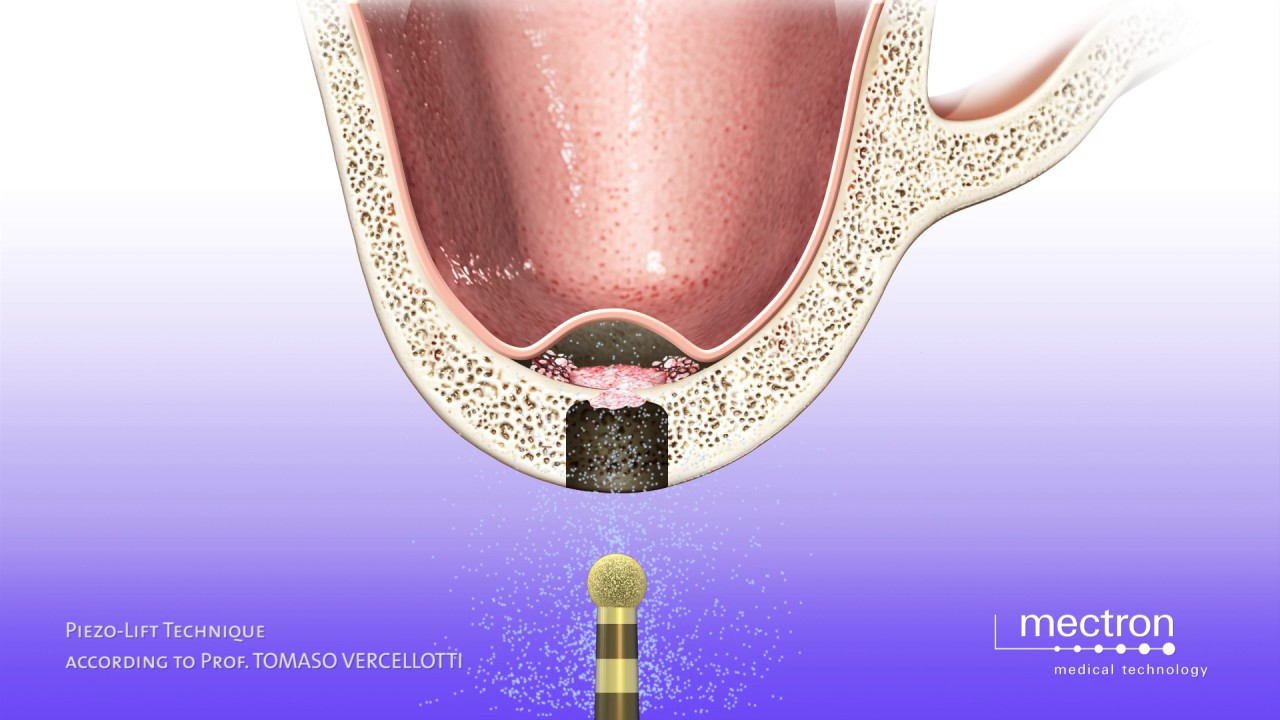 PIEZOSURGERY® — Piezo-Lift Technique — Crestal approach sinus lift