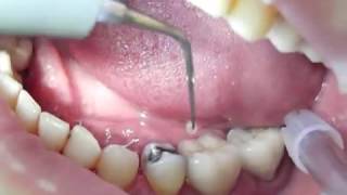 ACTEON-Dental-Tip-P2R-PERIOPRECISION