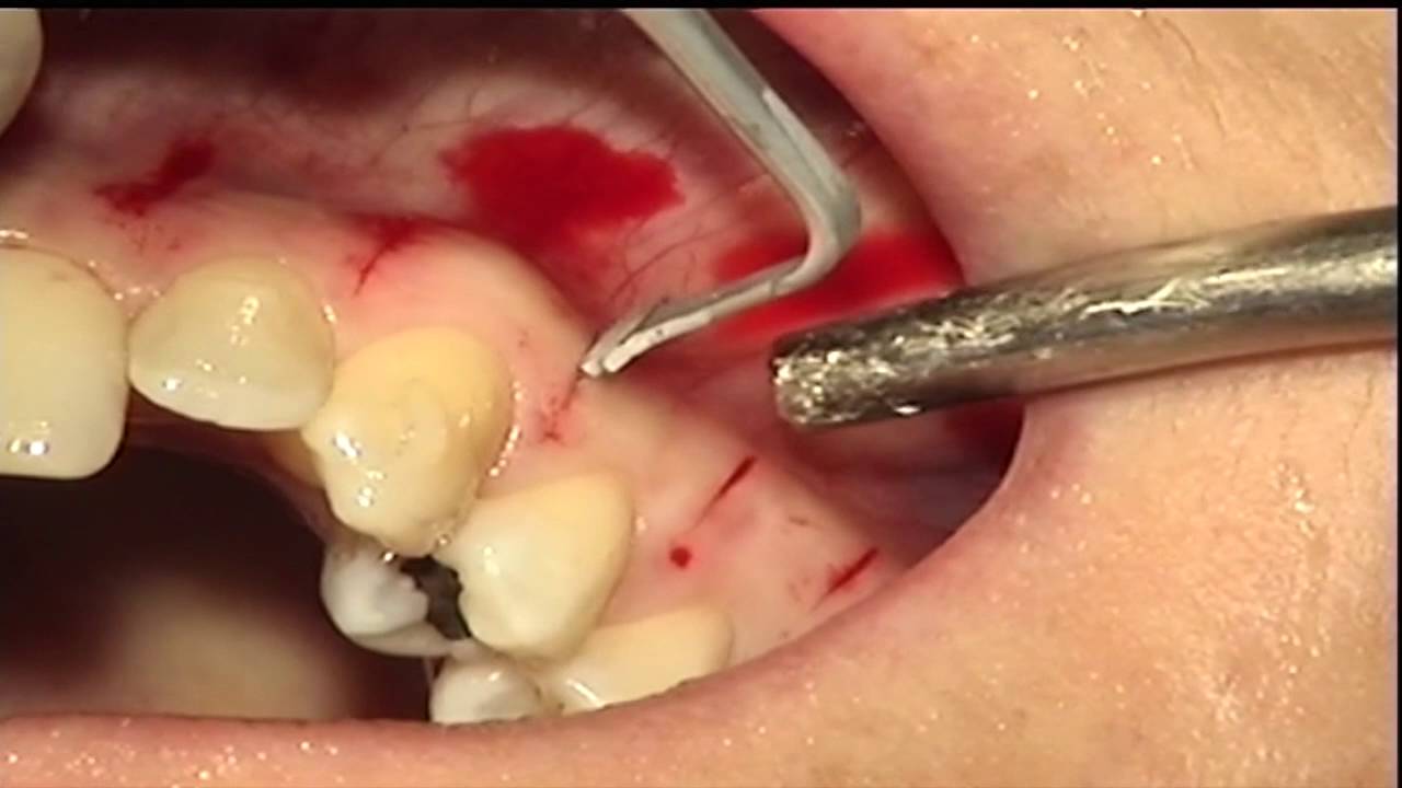 ACTEON Piezocision Clinical Case