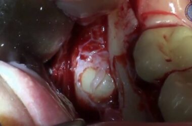 ACTEON-Removal-of-a-mandibular-impacted-3rd-molar-with-Piezotome