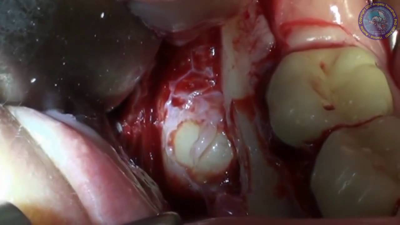 ACTEON Removal of a mandibular impacted 3rd molar with Piezotome