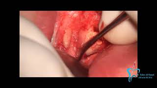 Apical-Surgery-With-Piezotome