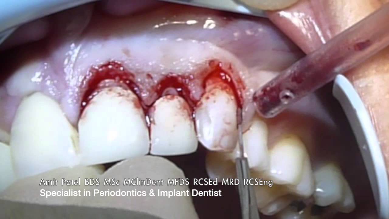 Crown Lengthening — Satelec Piezotome