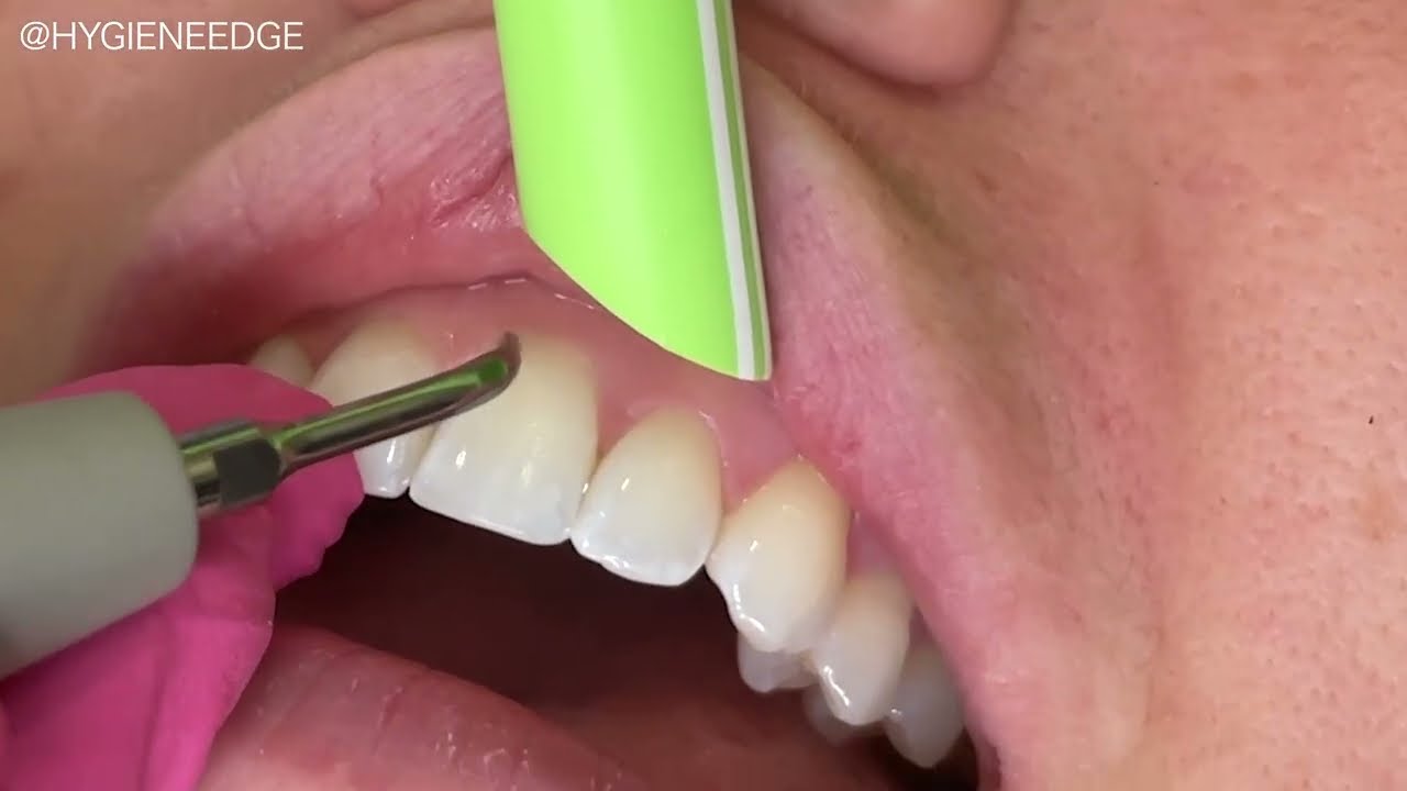 Dental Piezo How-To