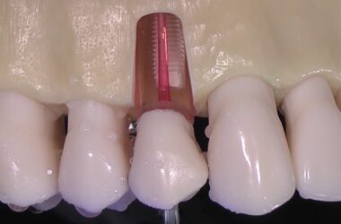 Endodontic-tips-ACTEON