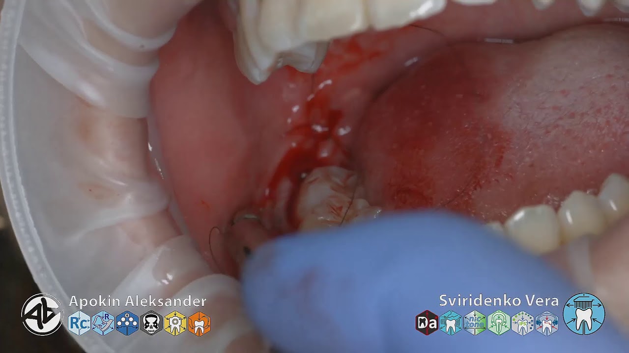 Extraction 48 Suturing  (multistream)