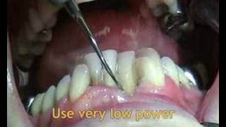 Instructional-video-on-Satelec-H3-tip-by-ACTEON