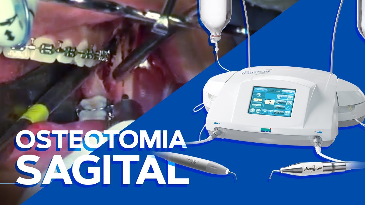 Osteotomia com Piezo Acteon Satelec