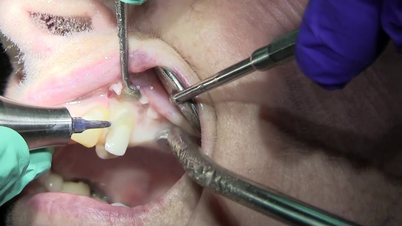 Piezotome CUBE Extraction by Dr. John Russo DDS