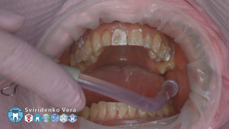 Professional-Oral-Hygiene-Acteon-Newtron-P5SX-Air-N-Go-Coxo-Cleanic-Montecarotte-FHD-multistream