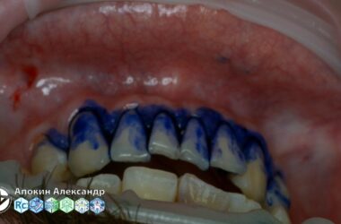 Professional-oral-hygiene-case-003-Acteon-DTE-Dentsply-Coxo-Floweis-3M-KerrHawe-livestream