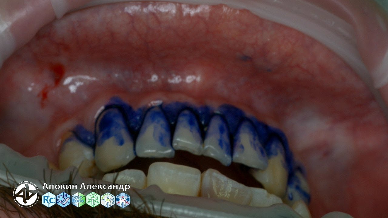 Professional oral hygiene — case 003 Acteon, DTE, Dentsply, Coxo, Floweis, 3M, KerrHawe (livestream)