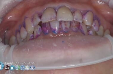 Professional-oral-hygiene-case-006-DTE-D7-Acteon-Air-N-Go-FloWeis-Cleanic-Enhance-FHD-multistream