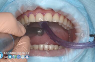 Professional-oral-hygiene-case-012-Acteon-DTE-Dentsply-Coxo-Floweis-3M-KerrHawe-FHD-multistream