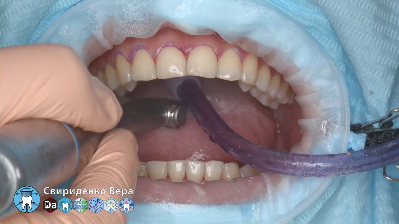 Professional oral hygiene -case 012 Acteon DTE Dentsply Coxo Floweis 3M KerrHawe (FHD multistream)