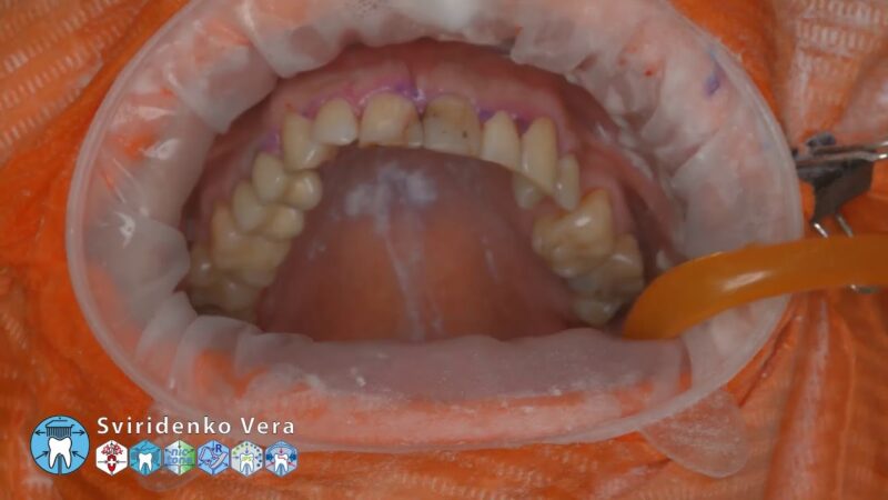 Professional-oral-hygiene-case-018-Acteon-DTE-Dentsply-Coxo-Floweis-3M-KerrHawe-FHD-multistream