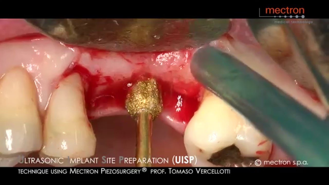 PIEZOSURGERY® Ultrasonic Implant Site Preparation (UISP) — technique