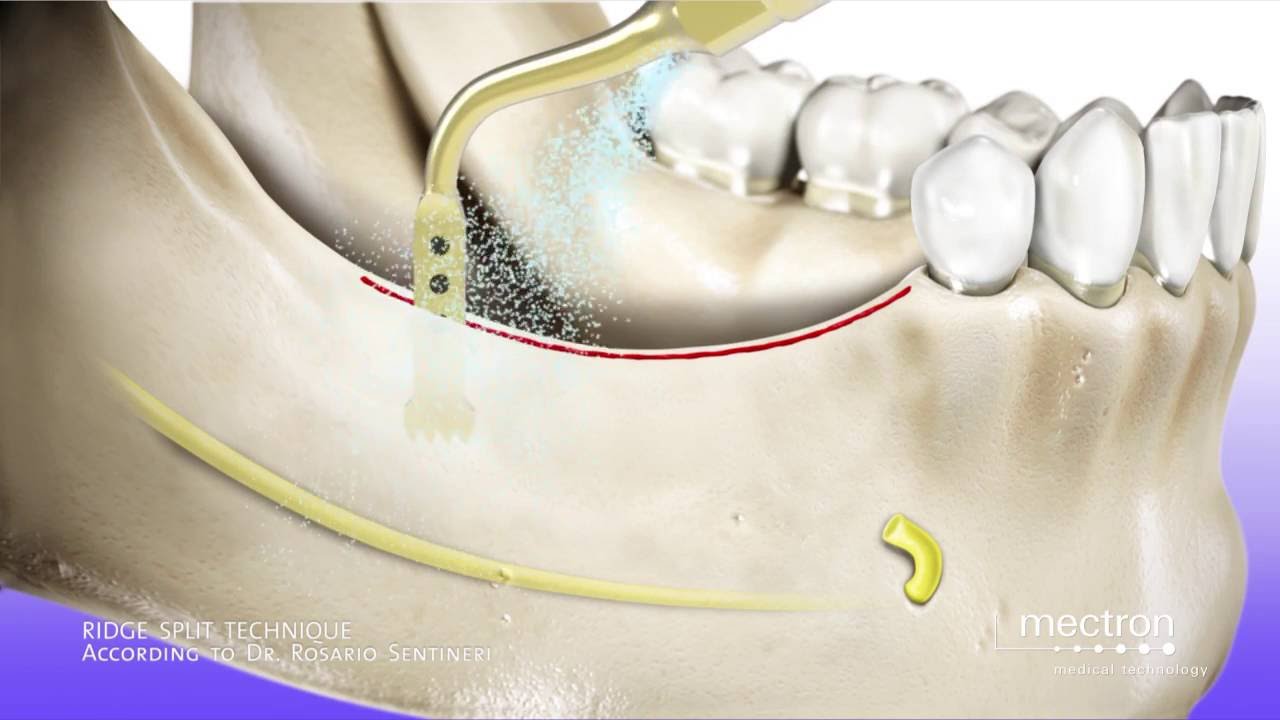 PIEZOSURGERY® — ridge split technique (animation)